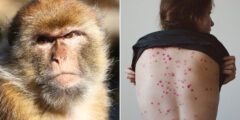 ما هو مرض جدري القرود وما مدى خطورته