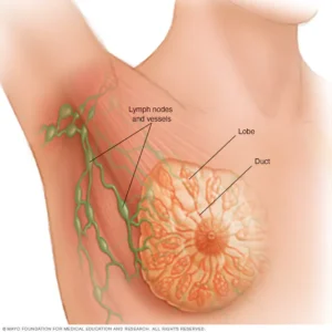 أعراض سرطان الثدي الالتهابي بالصور الحقيقية