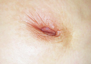 سرطان الثدي الالتهابي