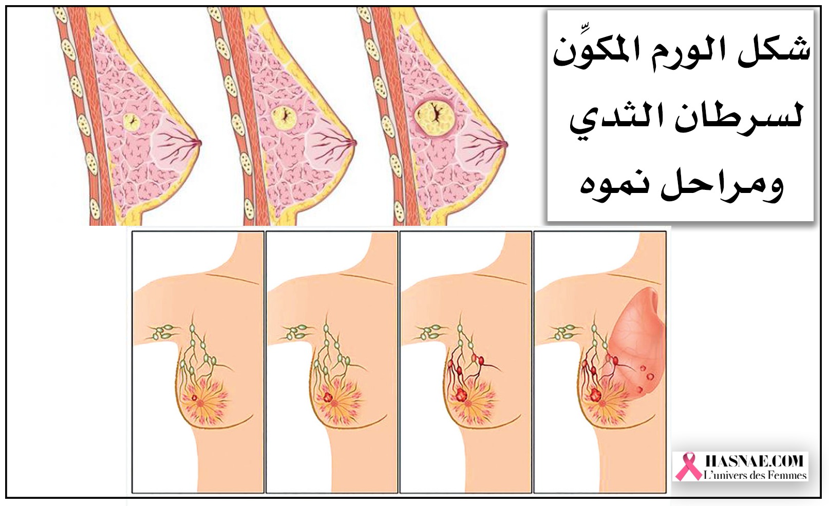 أعراض سرطان الثدي الحميد والخبيث