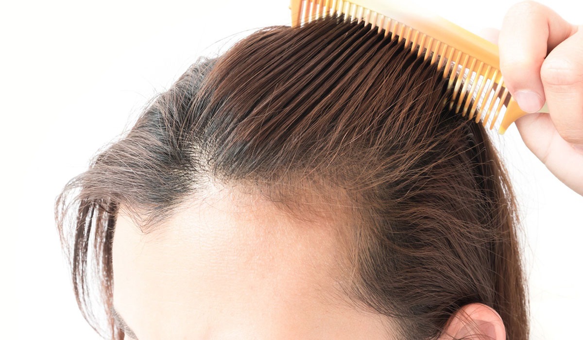 علاج تساقط الشعر عند النساء بالاعشاب مجرب